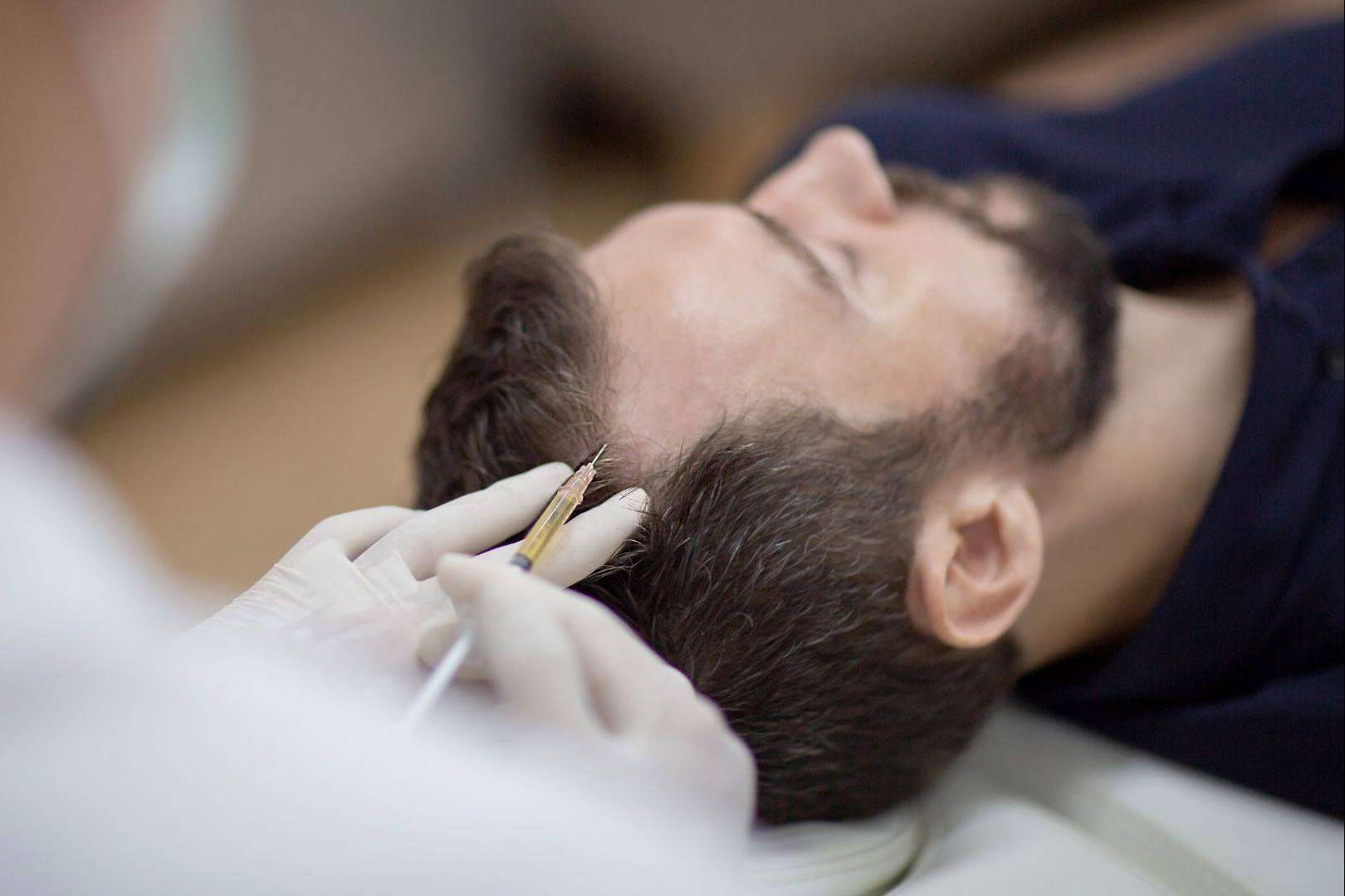 Plasma Rico en Plaquetas y Dutasteride, la potente terapia regeneradora de doble acción para la caída del cabello