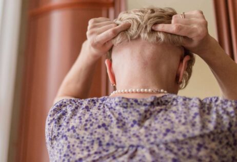Las prótesis capilares son una alternativa a la caída del cabello
