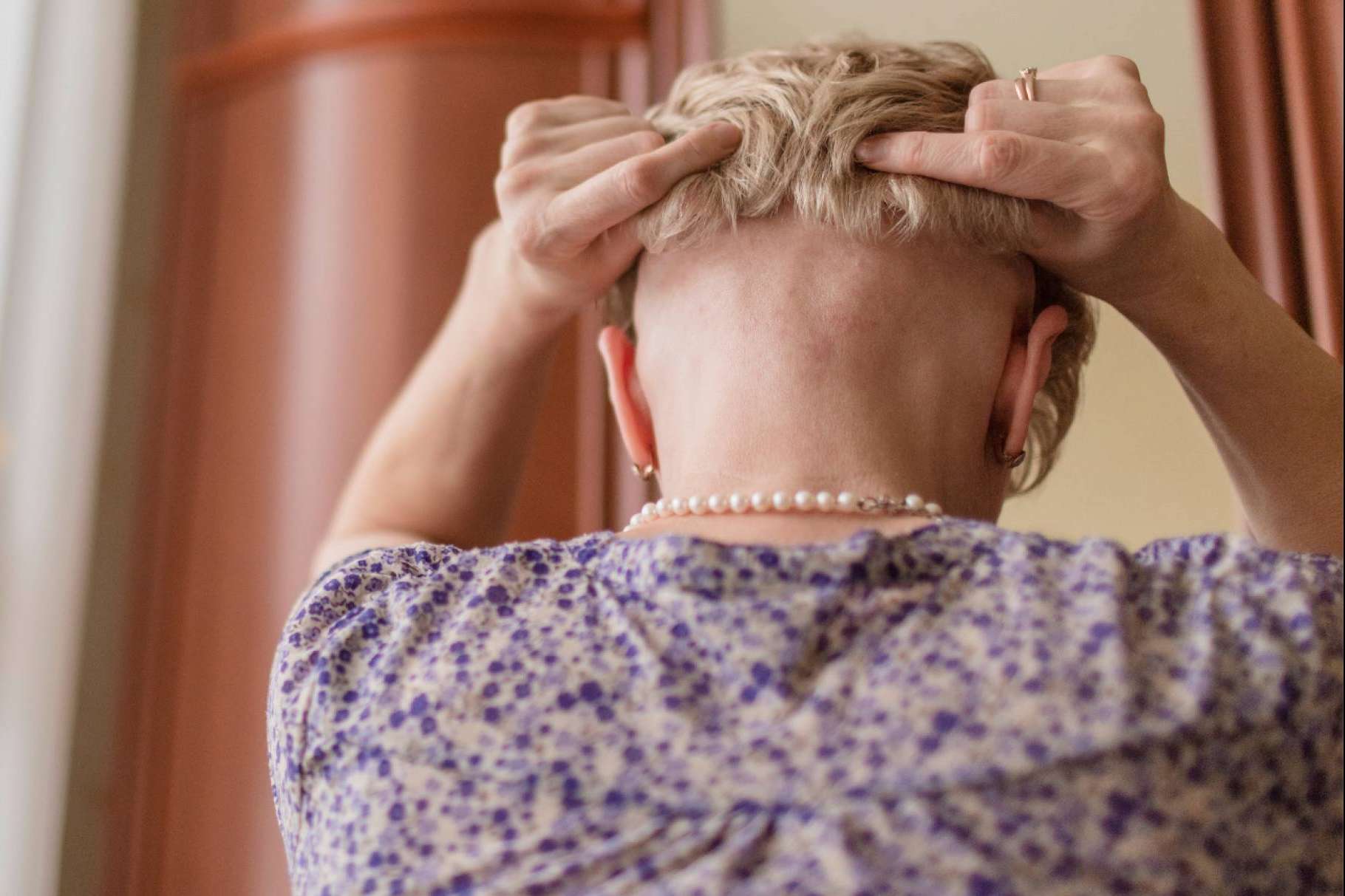 Las prótesis capilares son una alternativa a la caída del cabello