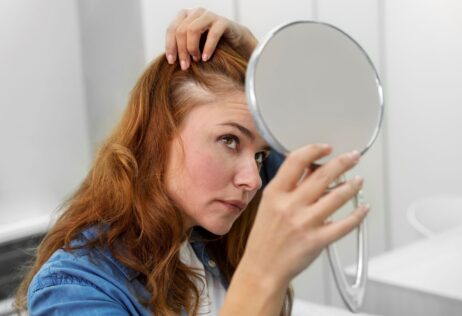 alopecia