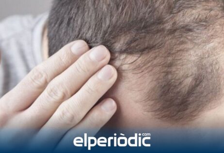 Mayor preocupación por la caída del cabello.