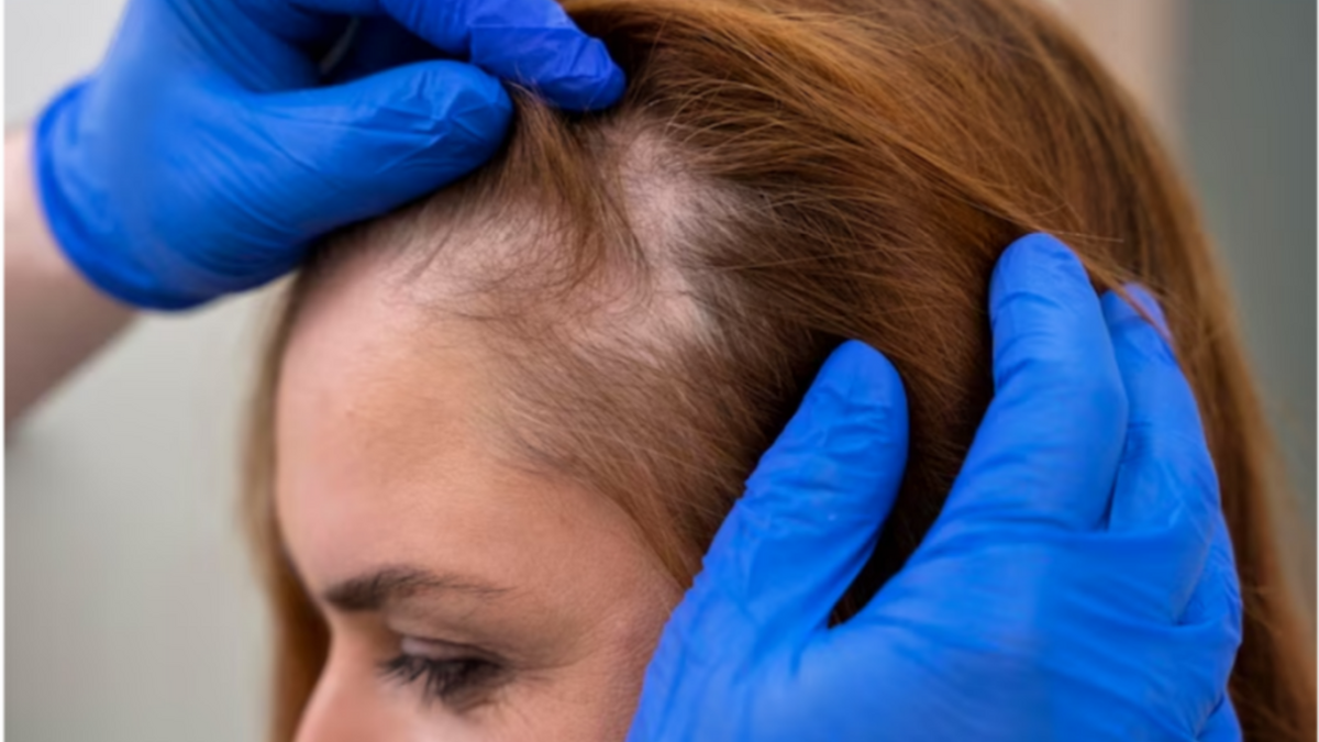 La relación entre el sedentarismo y la alopecia o caída del cabello